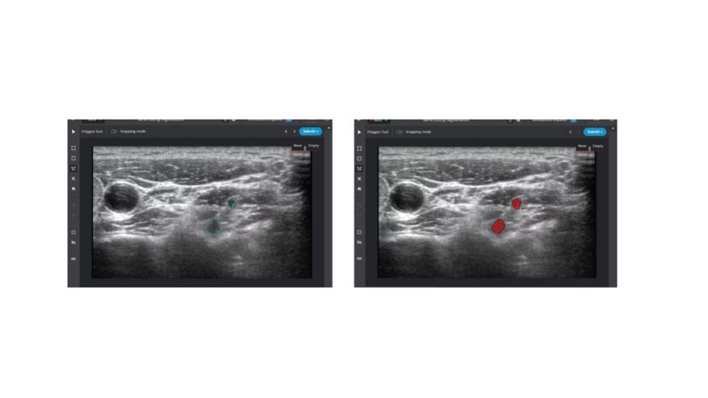 The image on the left represents ground truth, the target of the NerveTrack machine learning model. The image at right is annotated with the Intel Geti platform for inference model training proof of concept, based on 13 annotated ultrasound images.